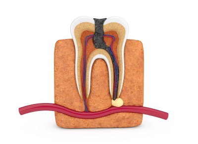 Apical Resection