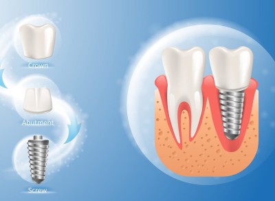 Implant Treatment