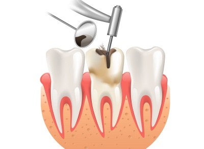 Conservative Dental Treatment