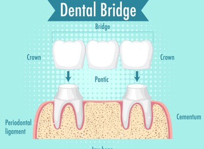 Bridge Prostheses