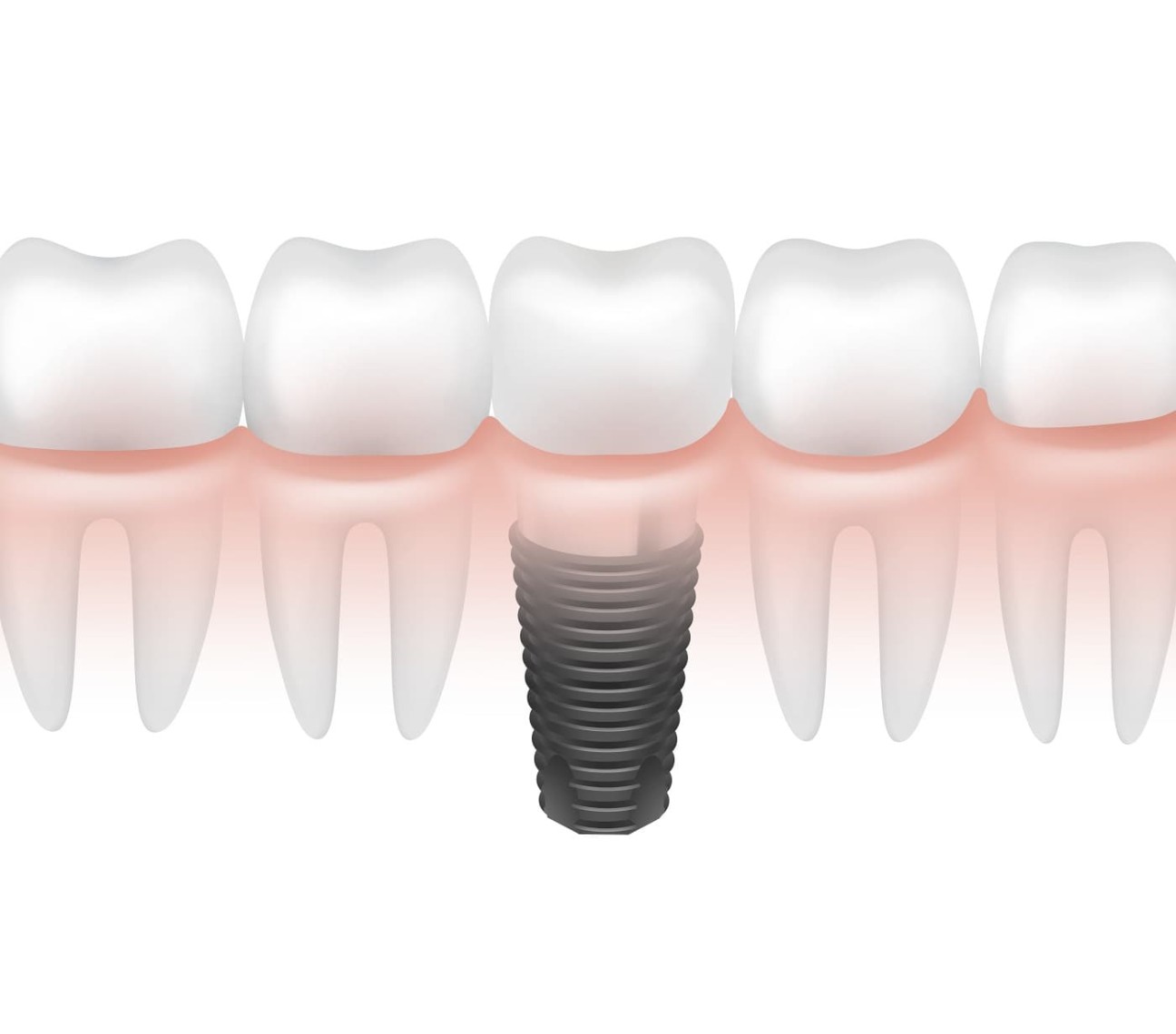 Dental Implant