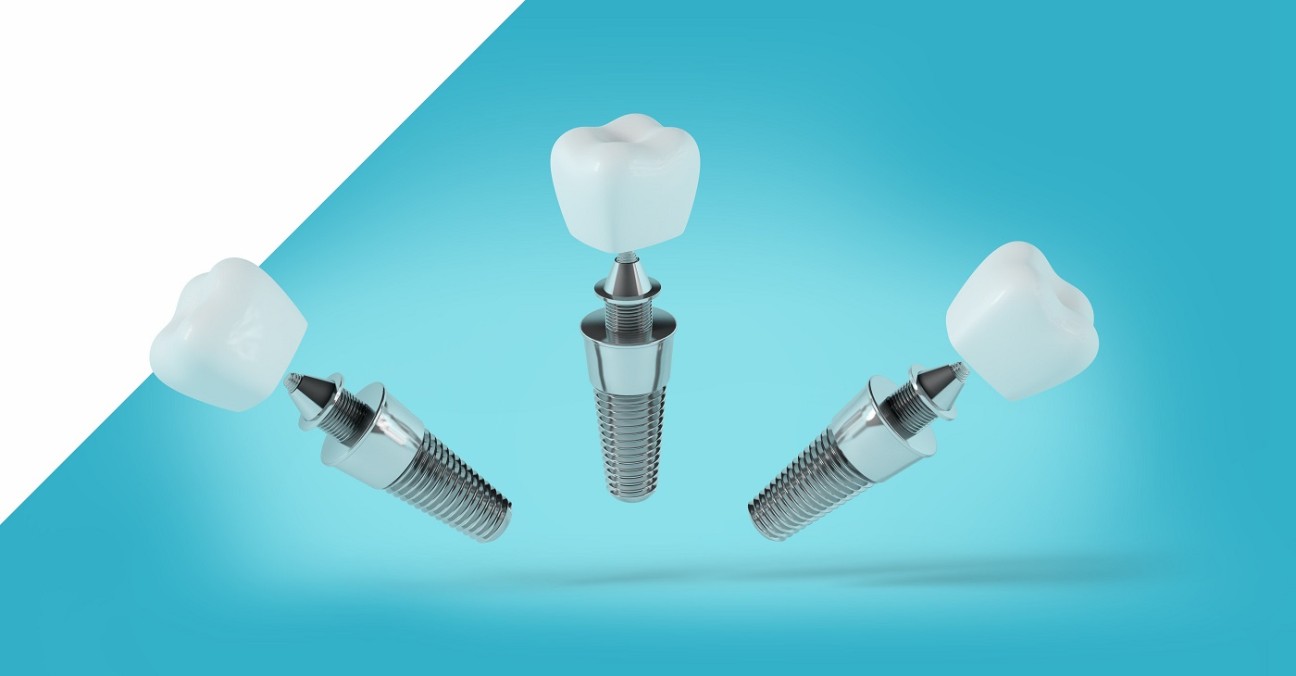 Implant Over Prosthesis